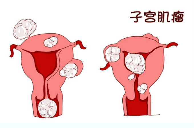 【科普】子宫肌瘤：到底是什么“瘤”？