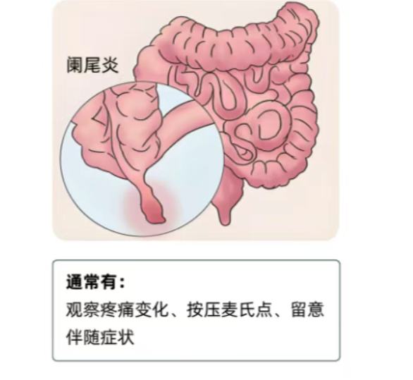【科普】儿童单纯性阑尾炎：家长需要知道的那些事儿